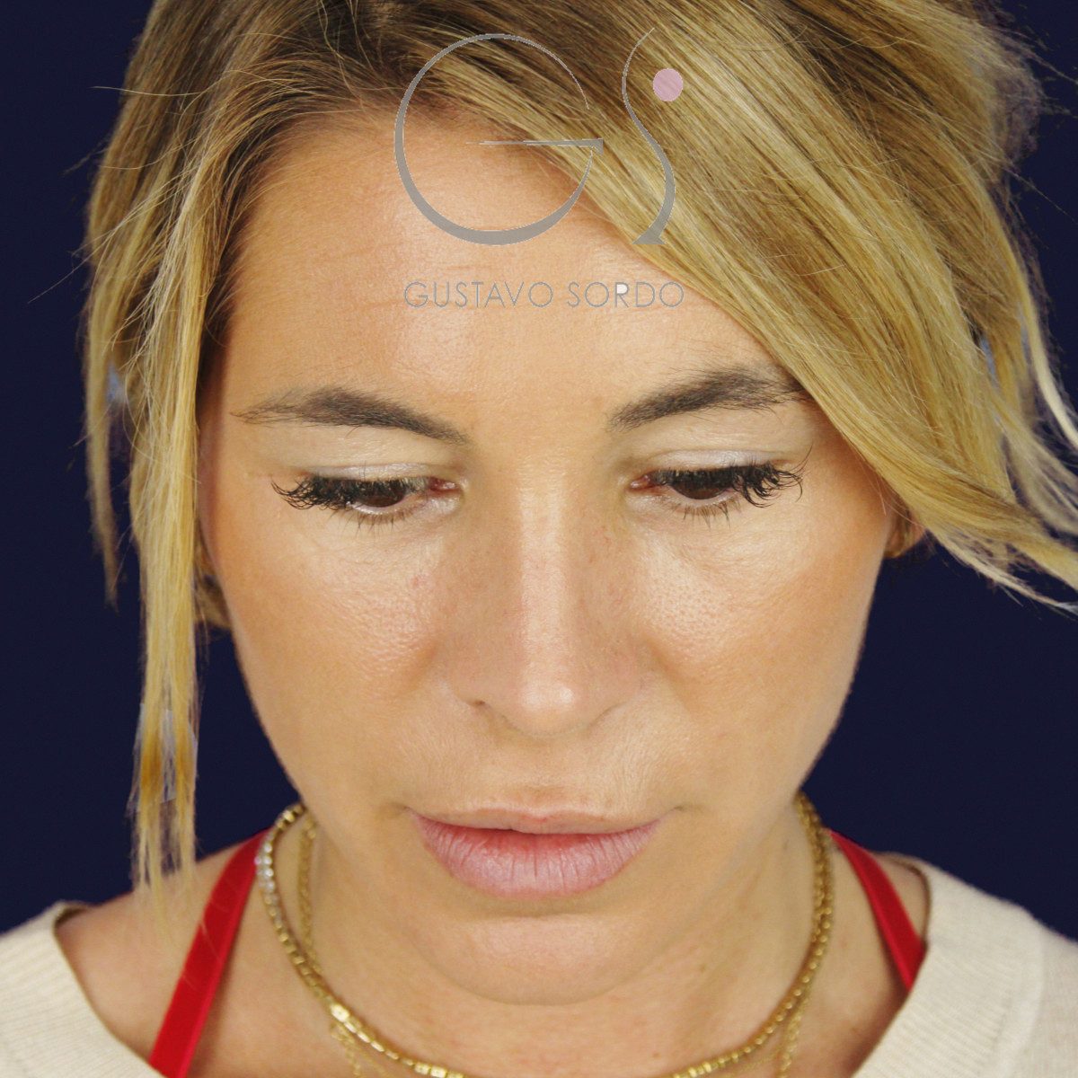 Después de rinoplastia secundaria de la punta sin costilla, a los dos meses, vista frontal con el mentón abajo