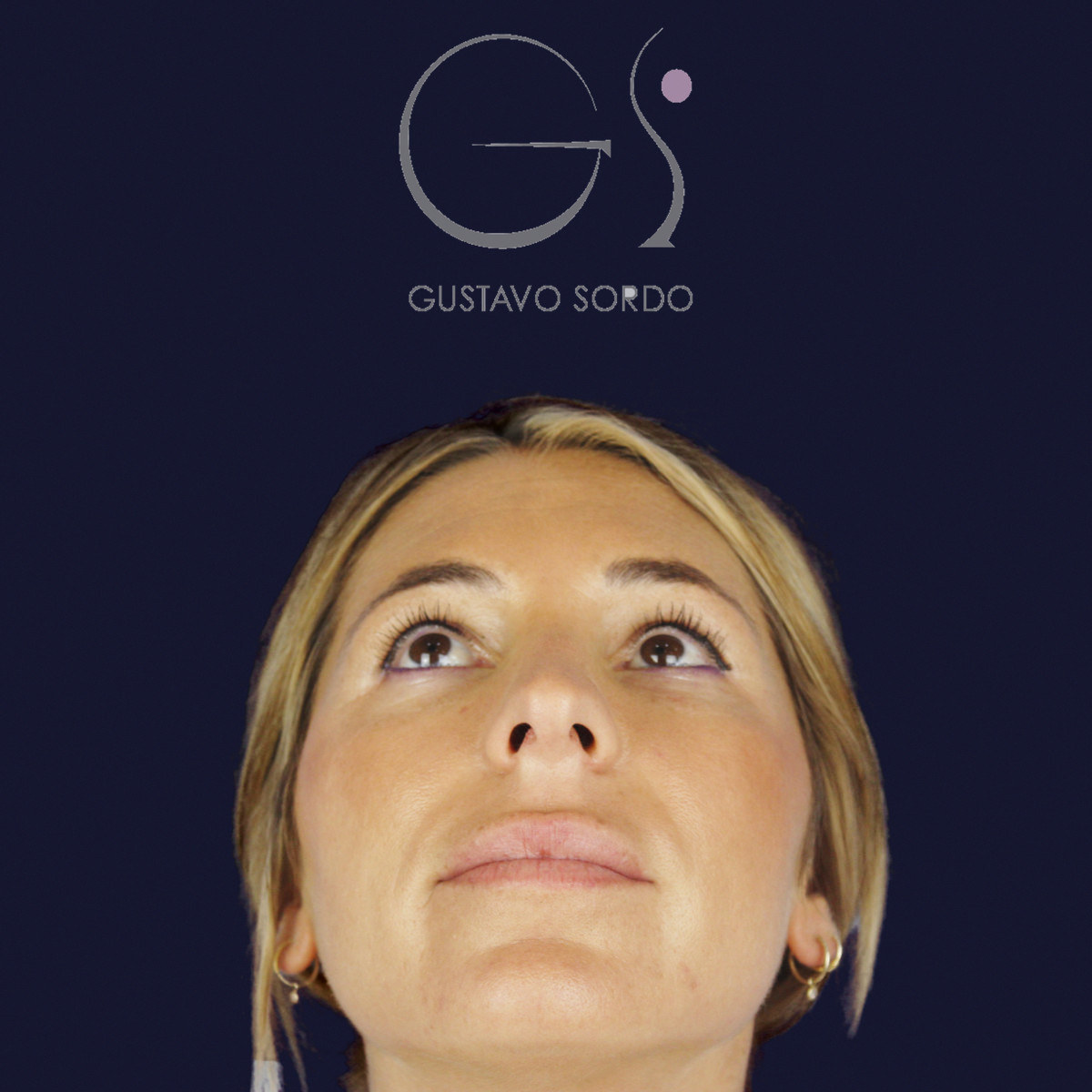 Antes de rinoplastia secundaria de la punta sin costilla, vista frontal con el mentón arriba