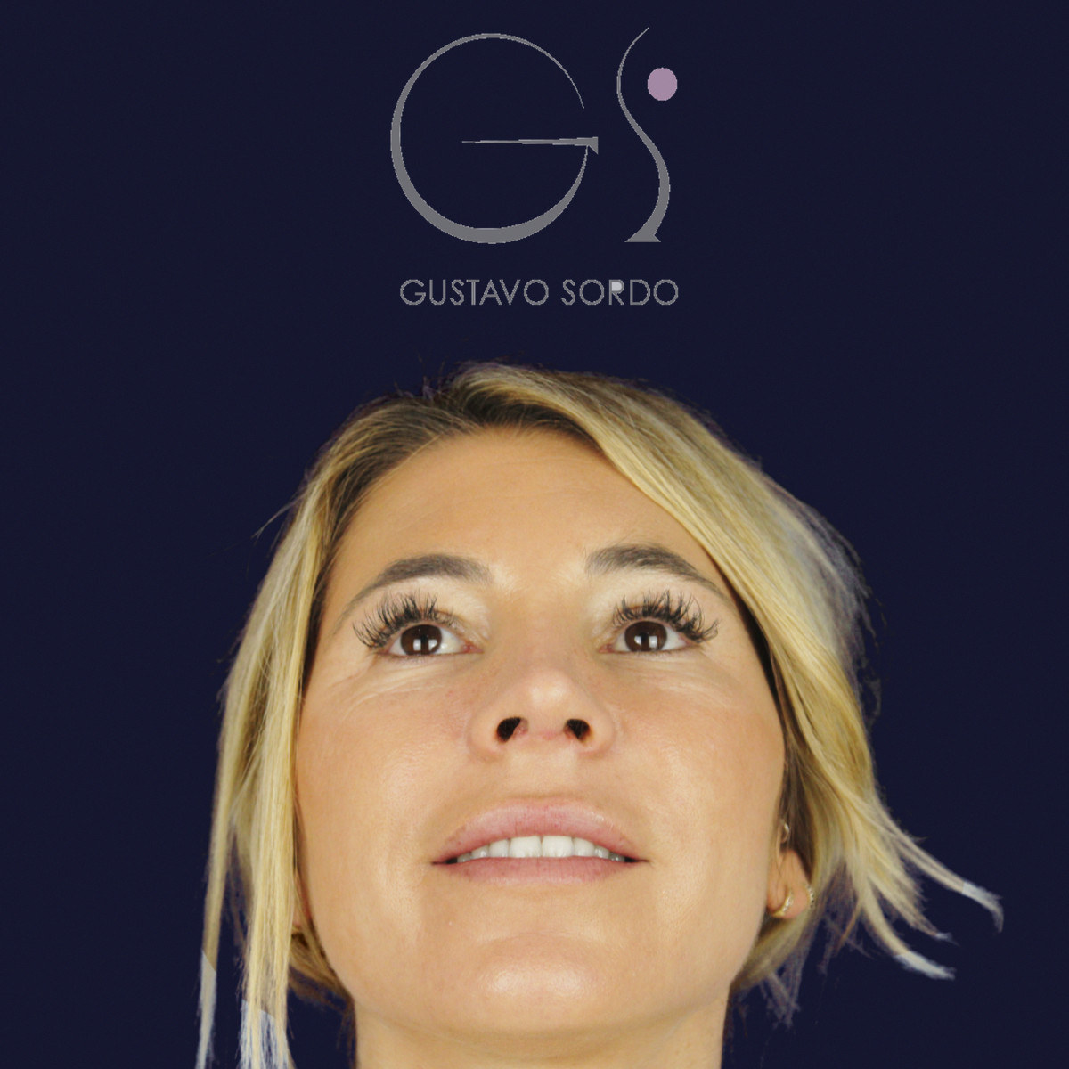 Después de rinoplastia secundaria de la punta sin costilla, a los dos meses, vista frontal con el mentón arriba