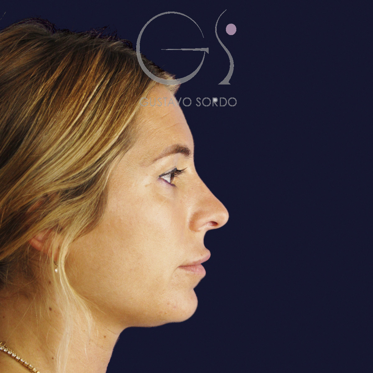 Antes de rinoplastia secundaria de la punta sin costilla, vista de perfil derecho