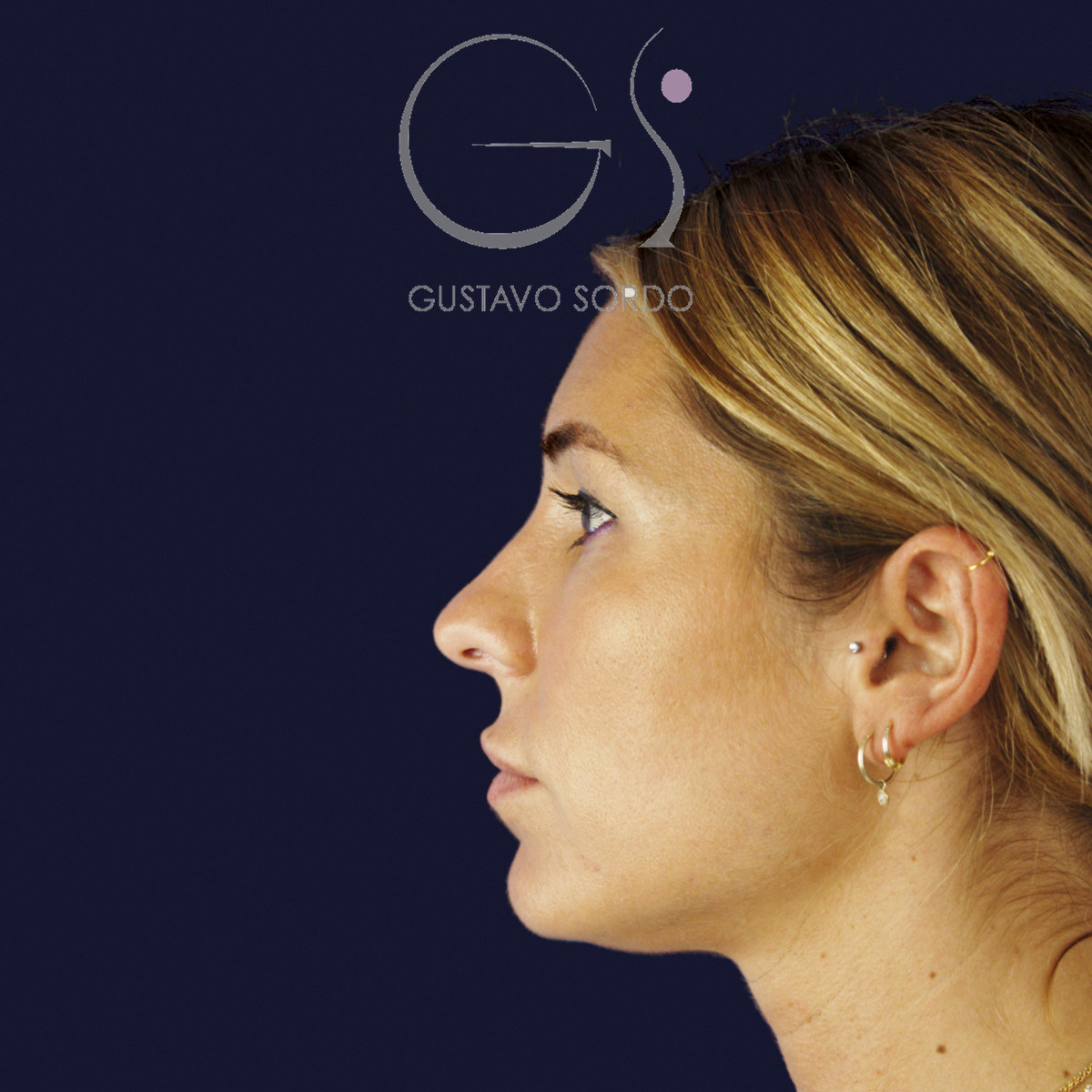 Antes de rinoplastia secundaria de la punta sin costilla, vista de perfil izquierdo