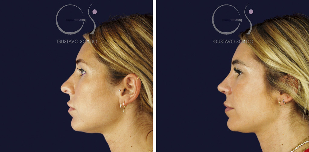 Rinoplastia secundaria de la punta sin costilla: antes y a los dos meses, perfil izquierdo