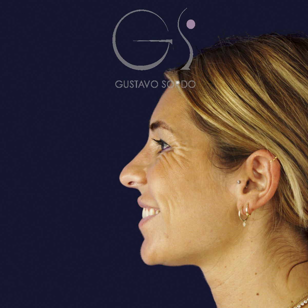 Antes de rinoplastia secundaria de la punta sin costilla, vista de perfil izquierdo sonriendo