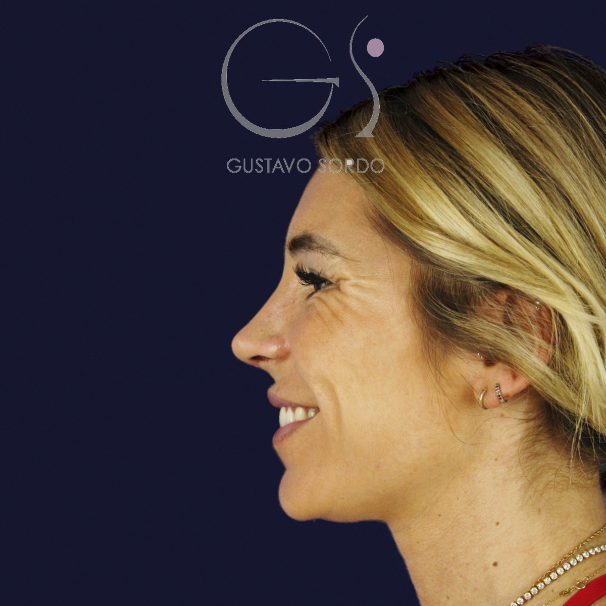 Después de rinoplastia secundaria de la punta sin costilla, a los dos meses, vista de perfil izquierdo sonriendo