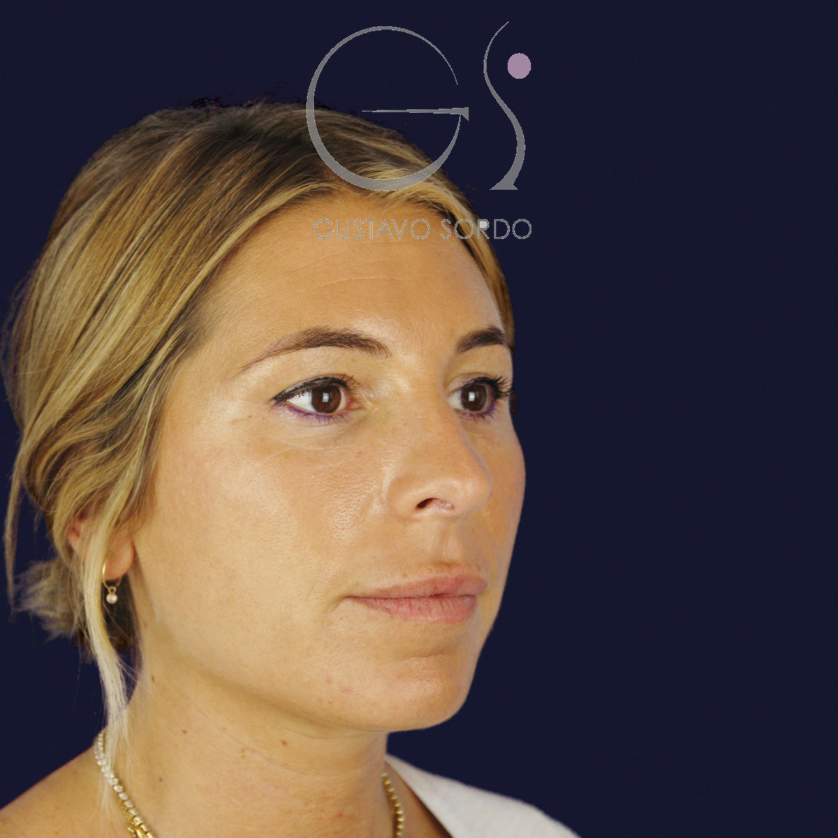 Antes de rinoplastia secundaria de la punta sin costilla, vista de semiperfil derecho
