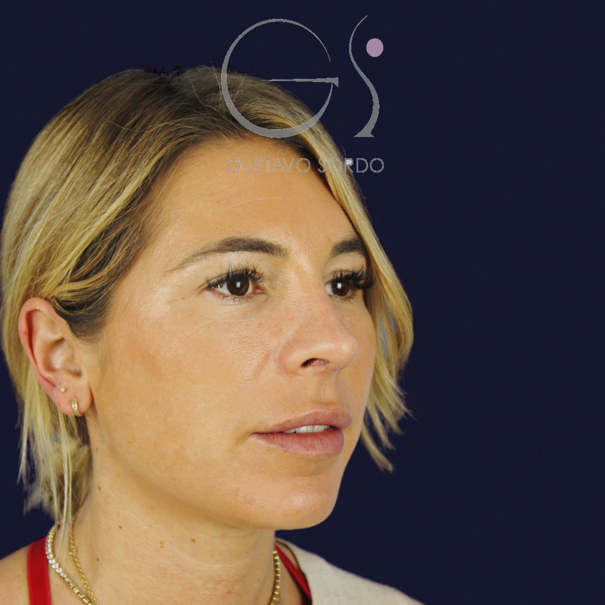 Después de rinoplastia secundaria de la punta sin costilla, a los dos meses, vista de semiperfil derecho