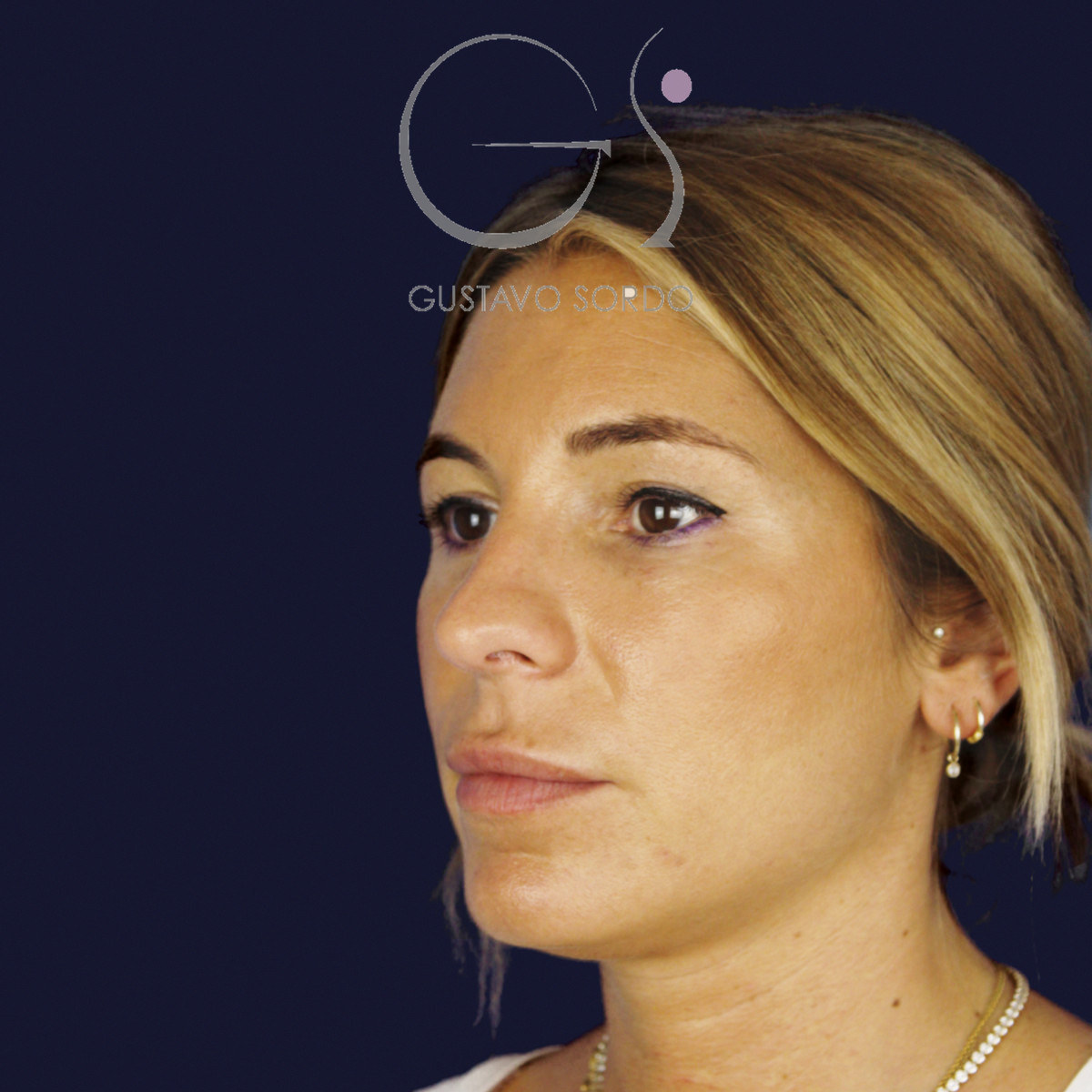 Antes de rinoplastia secundaria de la punta sin costilla, vista de semiperfil izquierdo