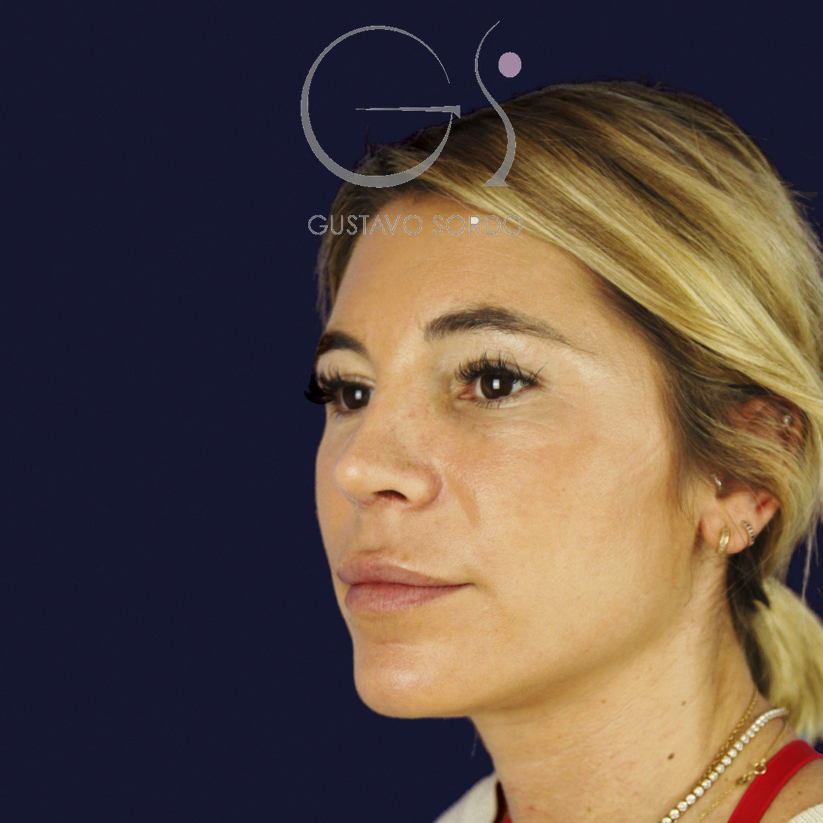 Después de rinoplastia secundaria de la punta sin costilla, a los dos meses, vista de semiperfil izquierdo