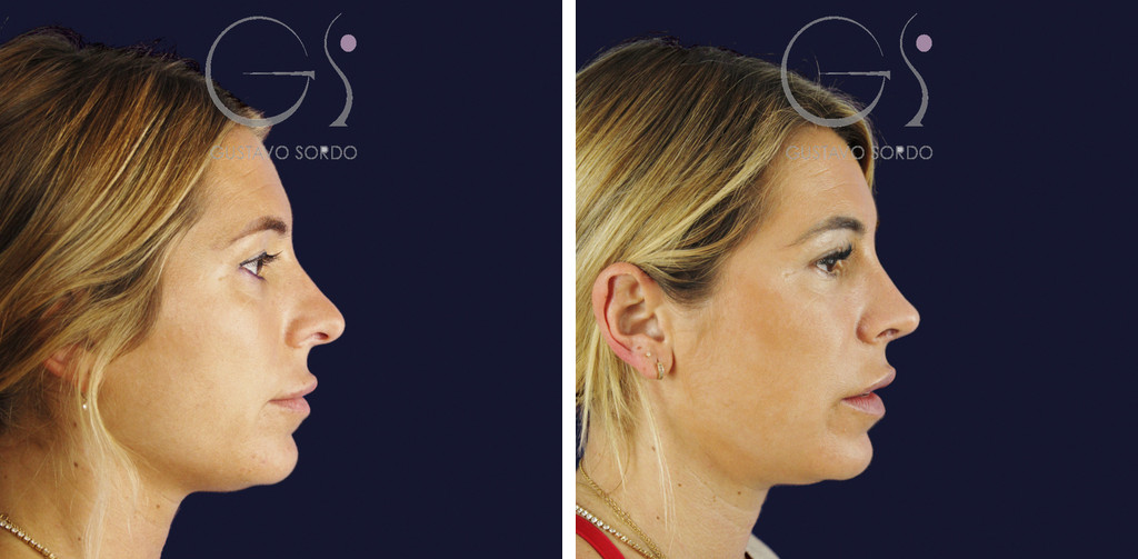 Rinoplastia secundaria de la punta sin costilla: antes y a los dos meses, perfil derecho