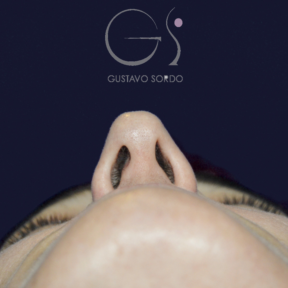 Antes de rinoseptoplastia extracorpórea en nariz desviada por un traumatismo, vista basal, desde abajo