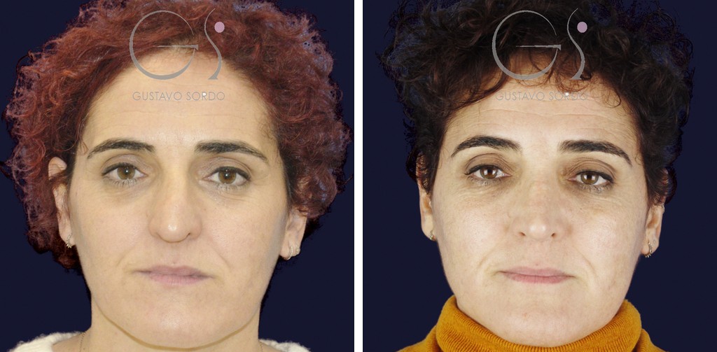 Rinoseptoplastia extracorpórea en nariz desviada por un traumatismo: antes y a los 11 meses, vista frontal