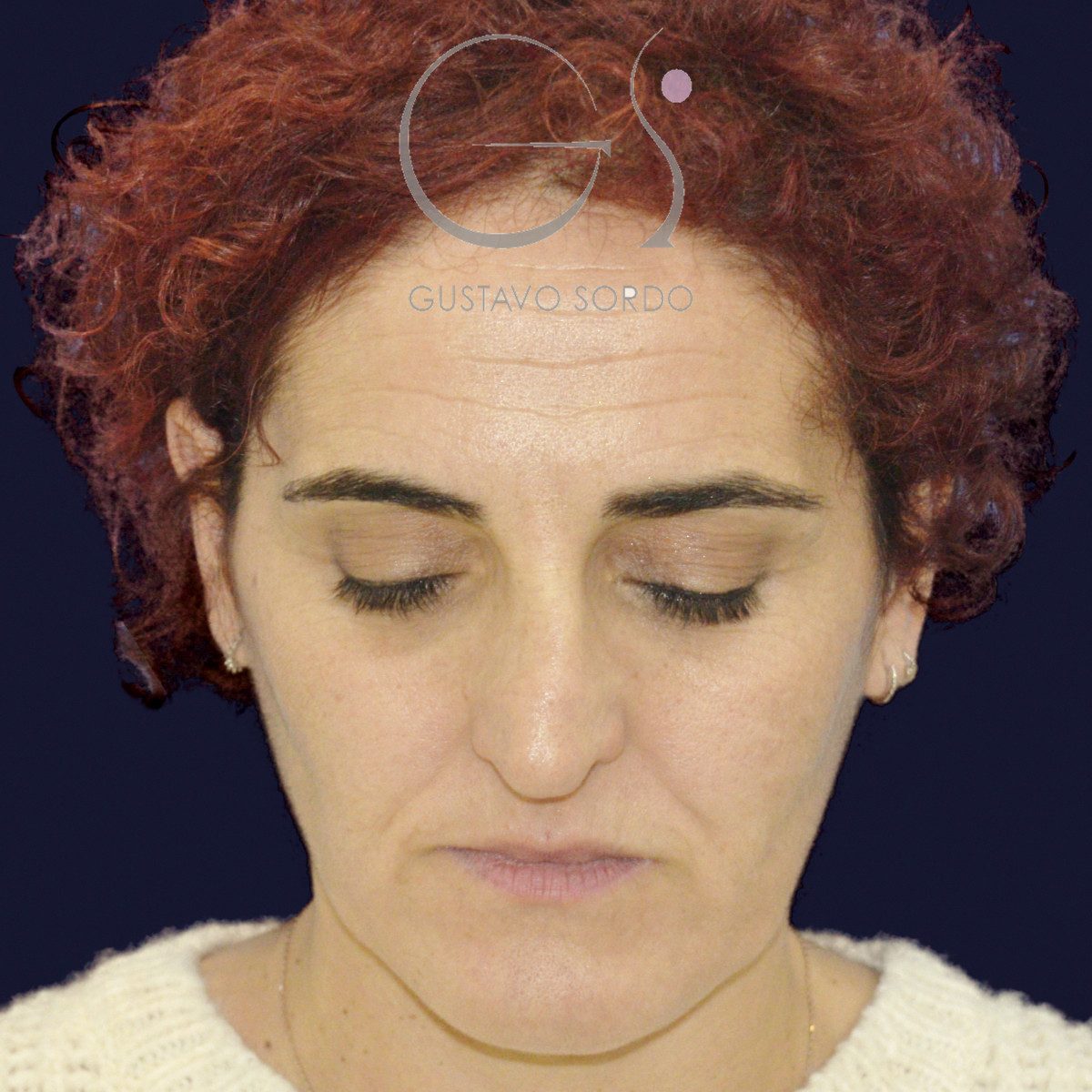 Antes de rinoseptoplastia extracorpórea en nariz desviada por un traumatismo, vista frontal con el mentón abajo