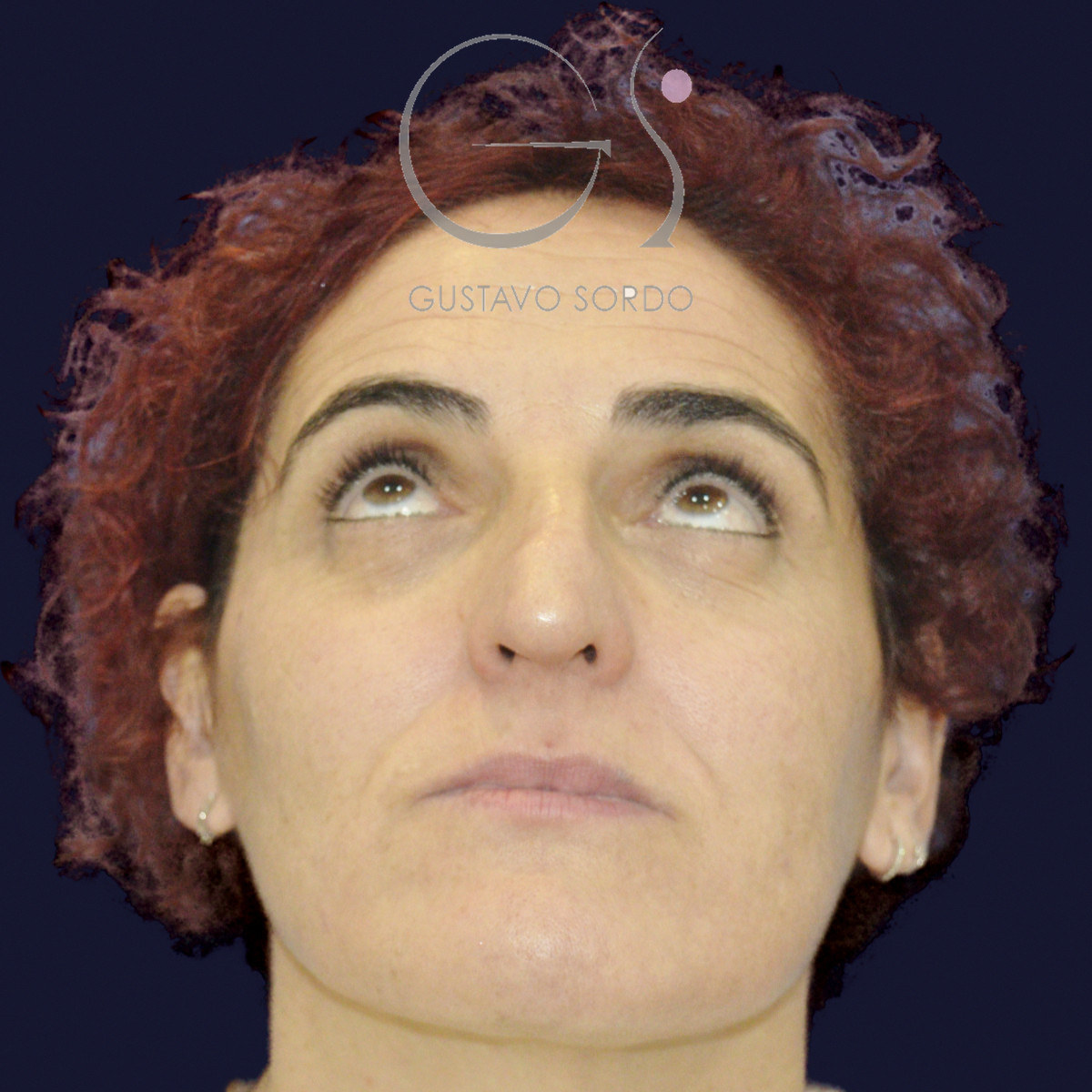 Antes de rinoseptoplastia extracorpórea en nariz desviada por un traumatismo, vista frontal con el mentón arriba
