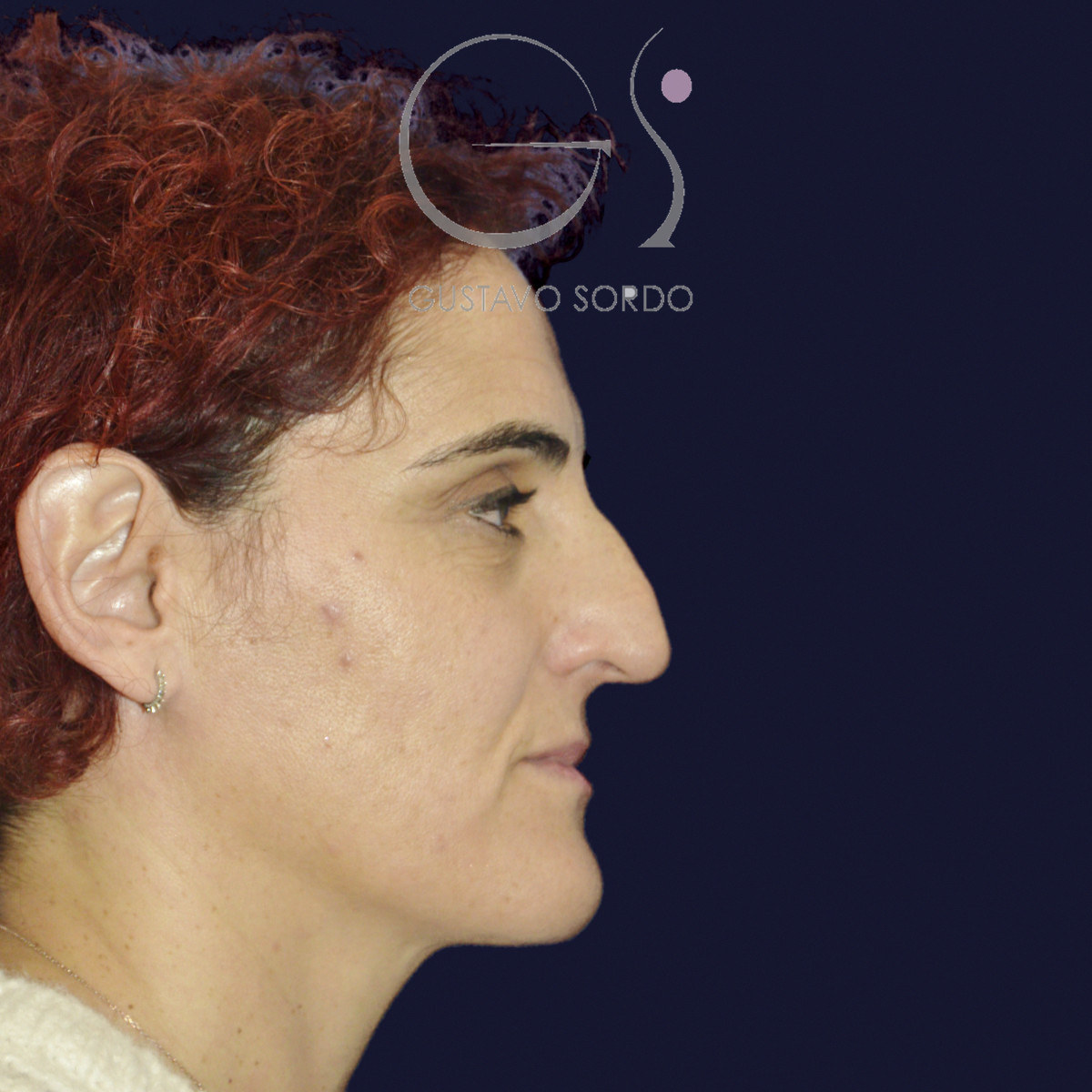 Antes de rinoseptoplastia extracorpórea en nariz desviada por un traumatismo, vista de perfil derecho
