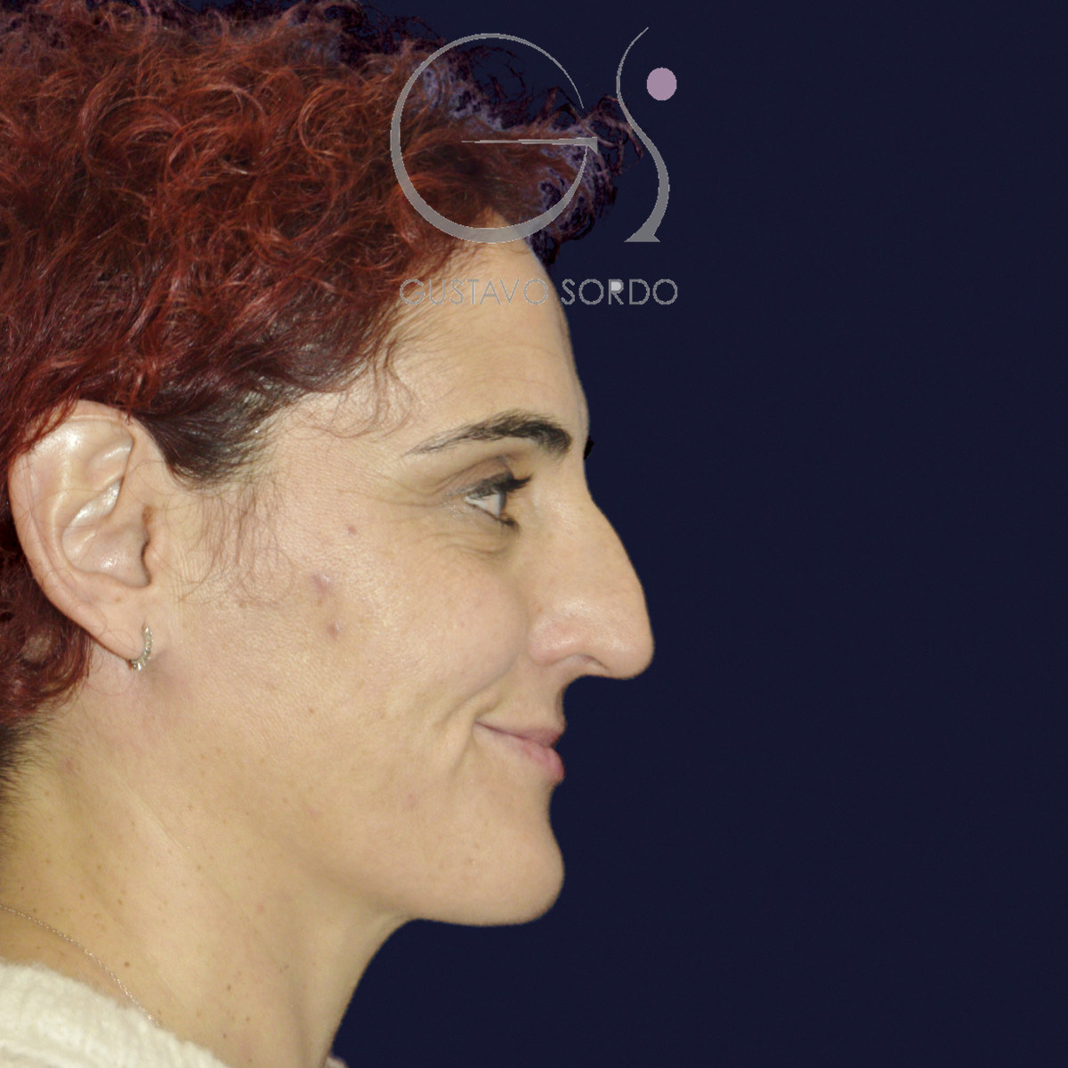 Antes de rinoseptoplastia extracorpórea en nariz desviada por un traumatismo, vista de perfil derecho sonriendo