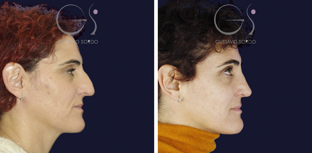 Rinoseptoplastia extracorpórea en nariz desviada por un traumatismo: antes y a los 11 meses, perfil derecho