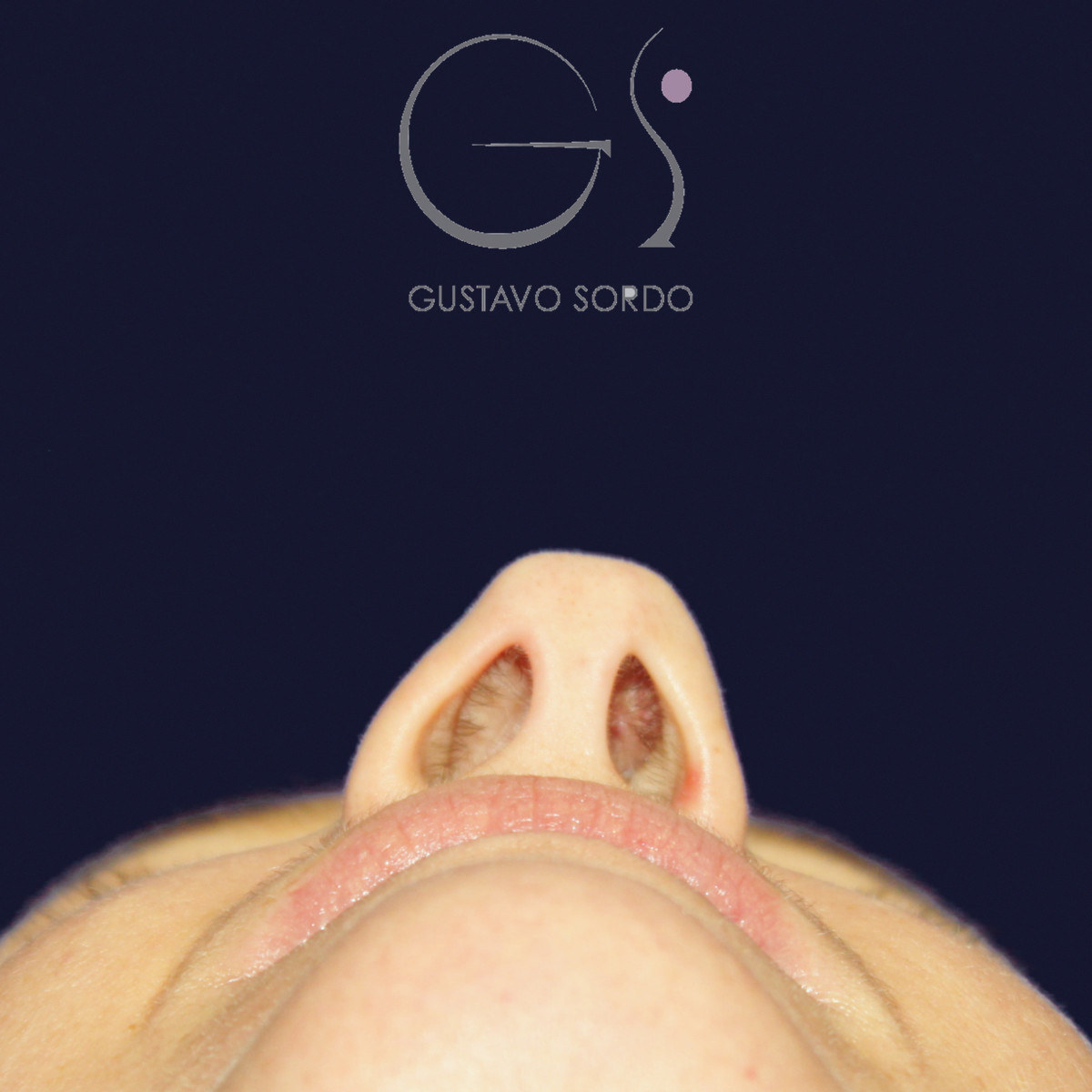 Before extracorporeal rhinoseptoplasty in a severely deviated septum, basal view
