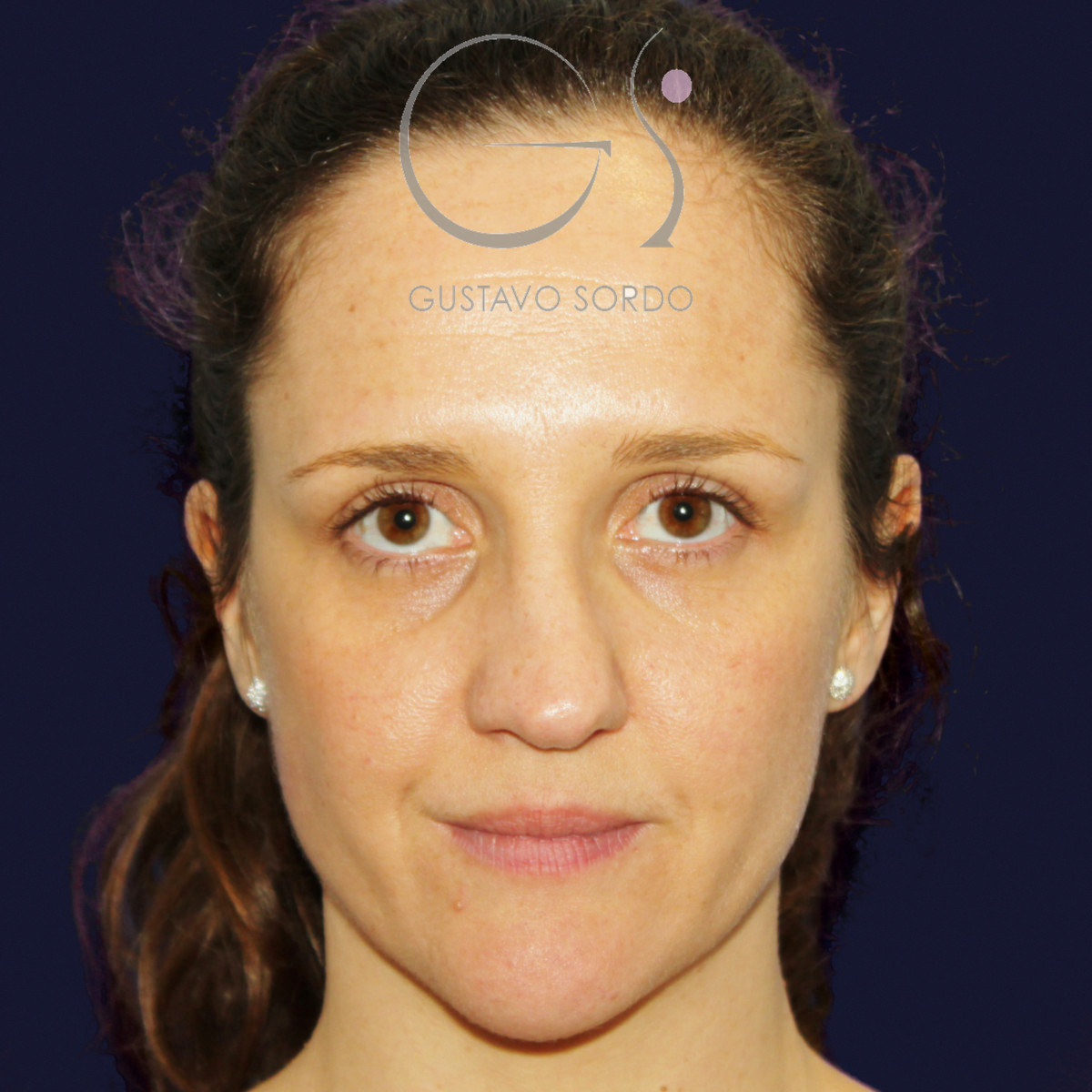 Before extracorporeal rhinoseptoplasty for a severely deviated septum, frontal view