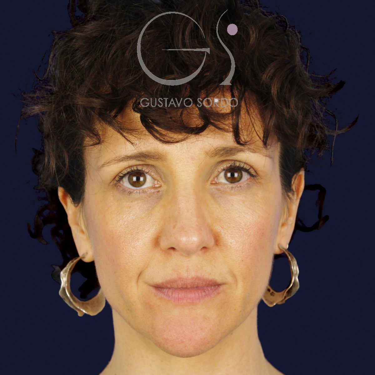 After extracorporeal rhinoseptoplasty for a severely deviated septum, at age six, frontal view