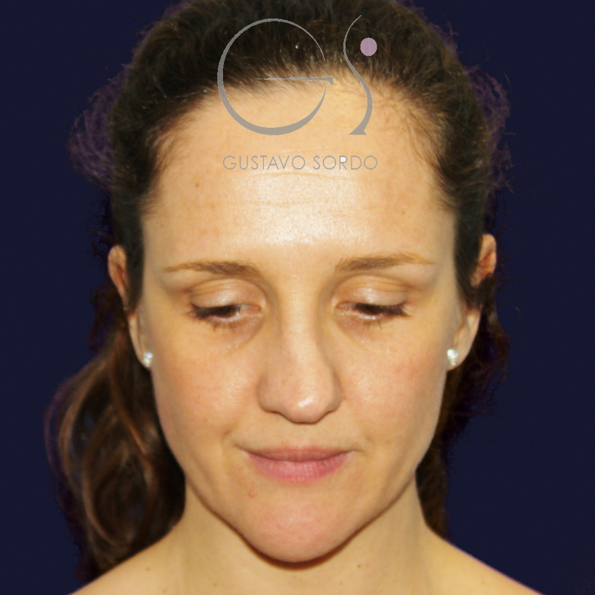 Before extracorporeal rhinoseptoplasty for a severely deviated septum, frontal view with the chin down