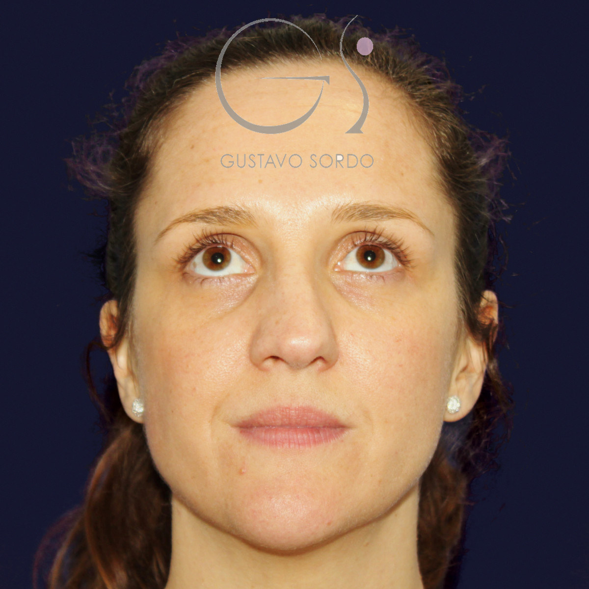 Before extracorporeal rhinoseptoplasty for a severely deviated septum, frontal view with the chin up