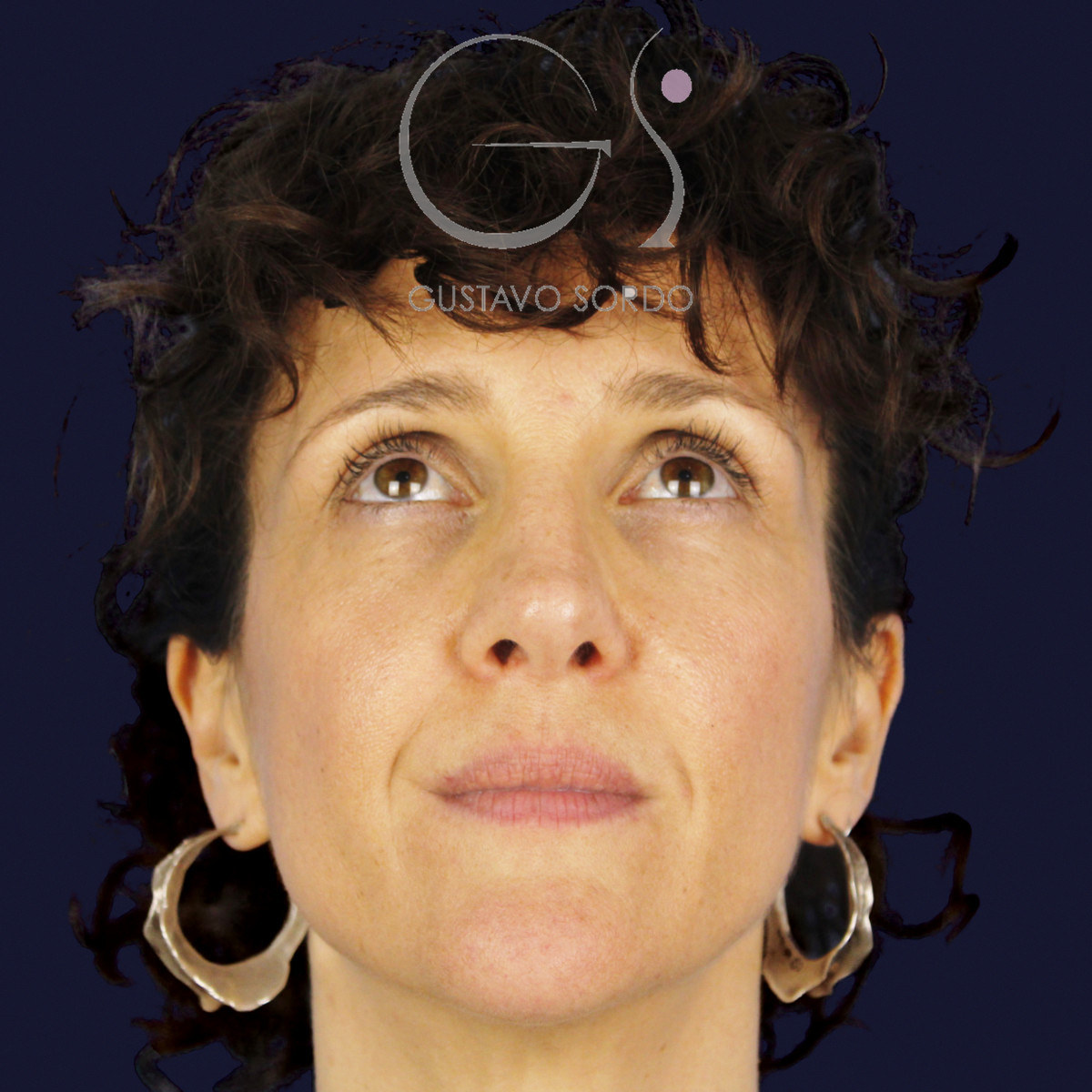 After extracorporeal rhinoseptoplasty for a severely deviated septum, at age six, frontal view with chin up