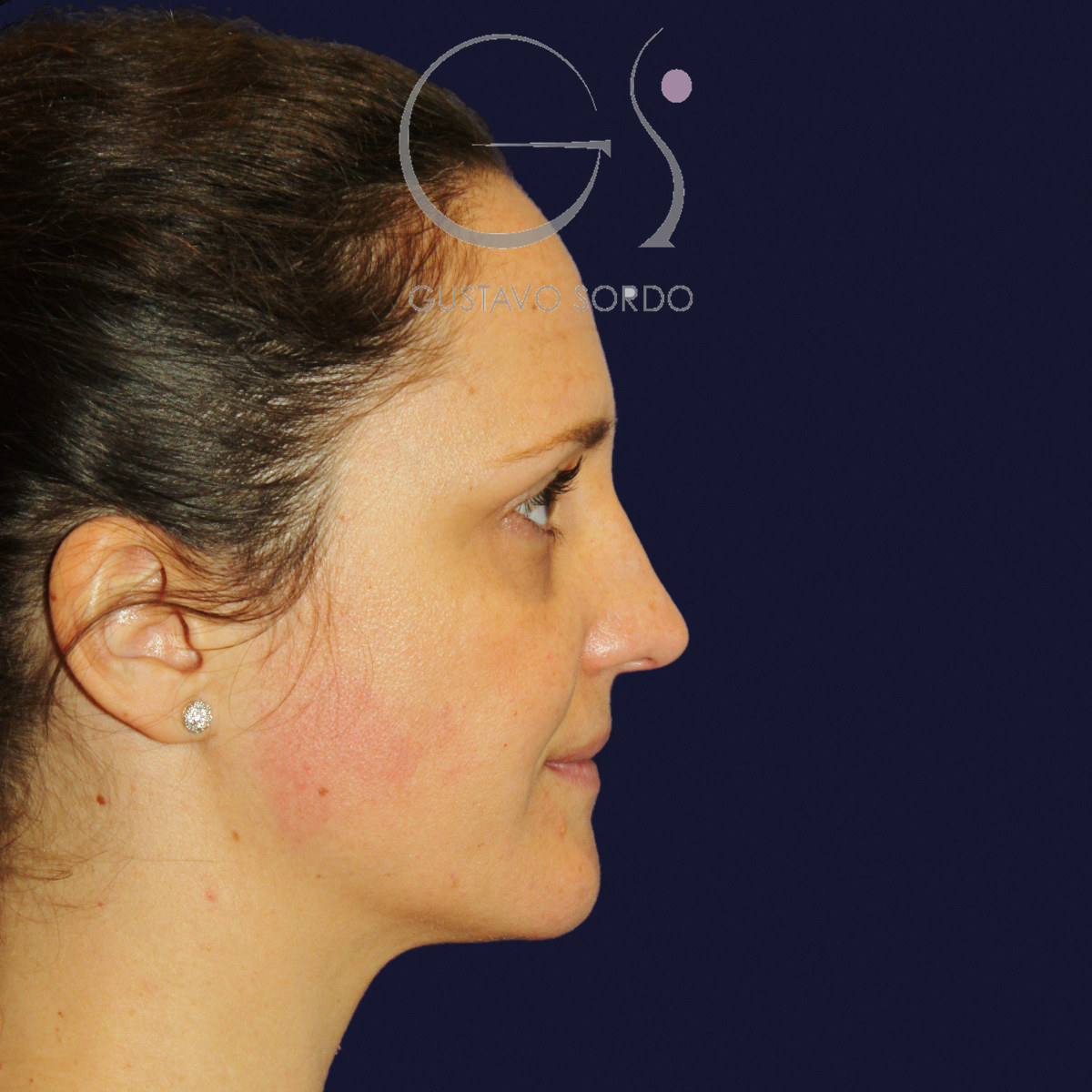 Before extracorporeal rhinoseptoplasty for a severely deviated septum, right profile view