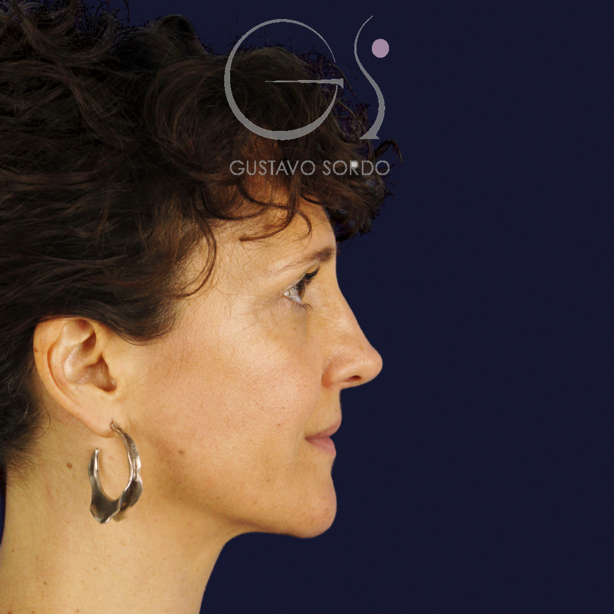 After extracorporeal rhinoseptoplasty for a severely deviated septum, at age six, right profile view