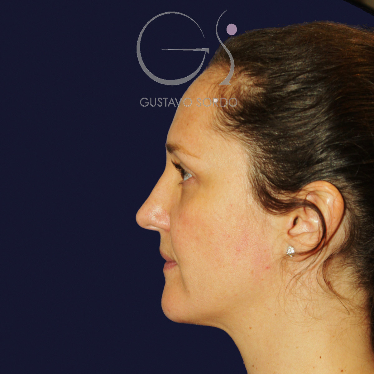 Before extracorporeal rhinoseptoplasty for a severely deviated septum, left profile view