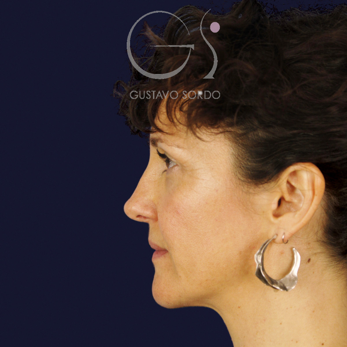 After extracorporeal rhinoseptoplasty for a severely deviated septum, at age six, left profile view