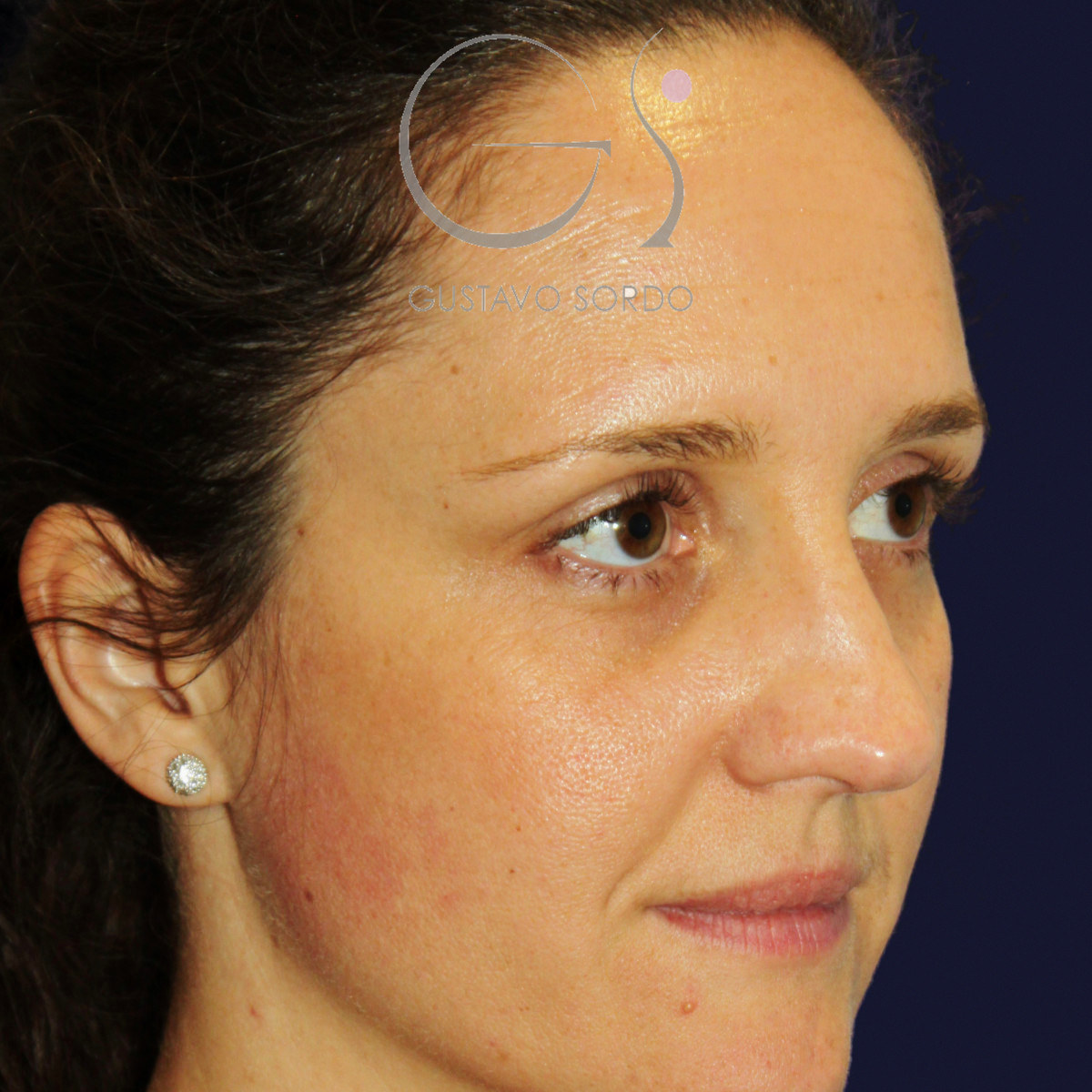 Before extracorporeal rhinoseptoplasty for a severely deviated septum, right semi-profile view