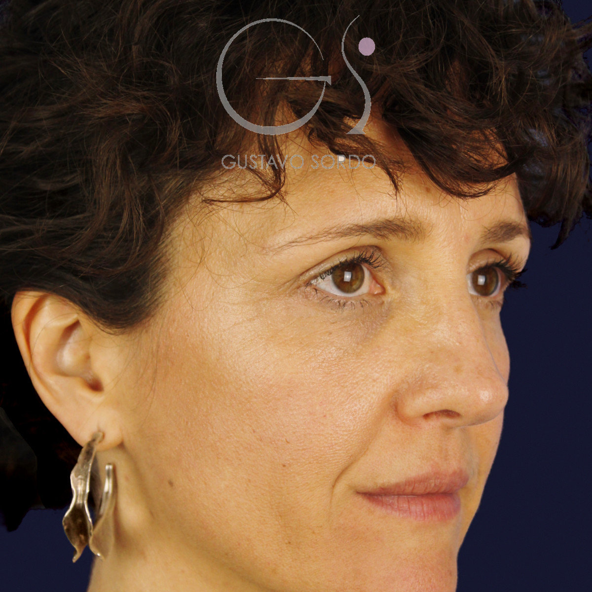 After extracorporeal rhinoseptoplasty for a severely deviated septum, at age six, right semi-profile view