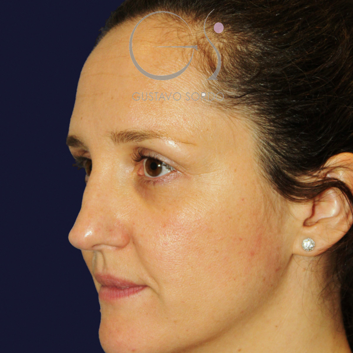 Before extracorporeal rhinoseptoplasty for a severely deviated septum, left semi-profile view
