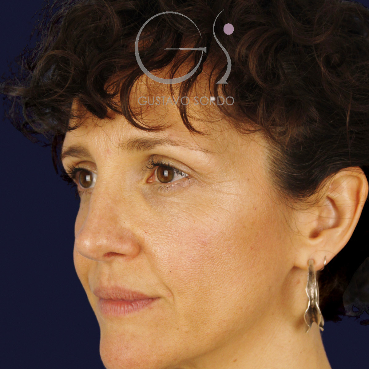After extracorporeal rhinoseptoplasty for a severely deviated septum, at age six, left semi-profile view