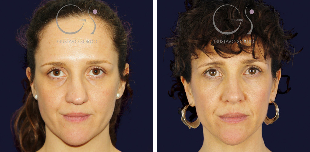 Rinoseptoplastia extracorpórea en tabique muy desviado: antes y a los seis años, vista frontal
