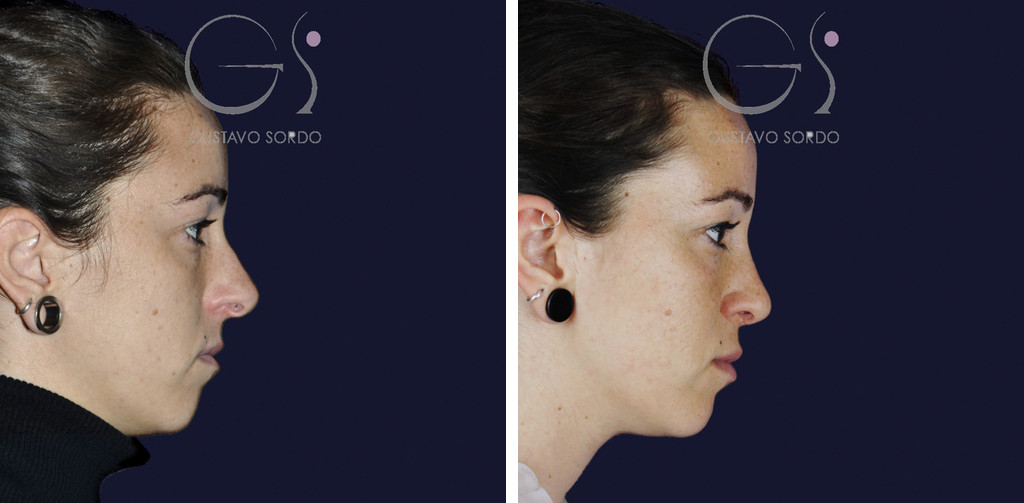 Rinoseptoplastia en nariz muy desviada: antes y a los seis meses, perfil derecho