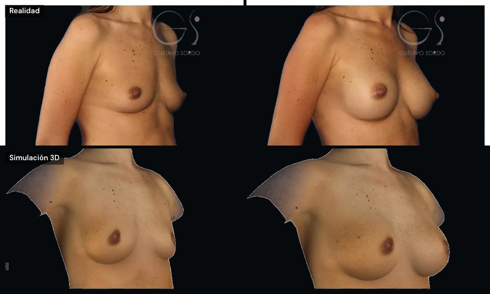 Simulación 3D y resultado real de un aumento de pecho, vista de perfil