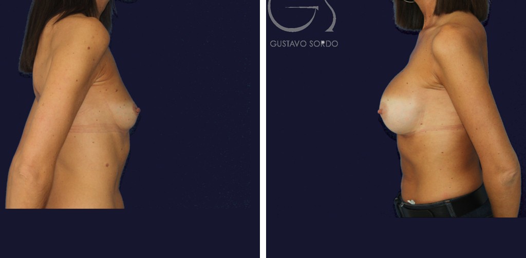 Antes y después de un aumento de pecho con prótesis anatómicas de 330 cc en una paciente con pectus excavatum leve, caso operado por el Dr. Gustavo Sordo en Madrid