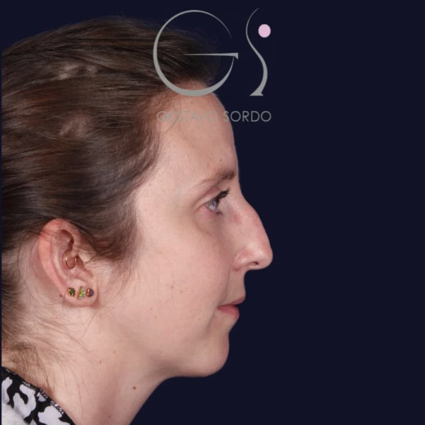 Antes y después de rinoplastia en nariz aguileña