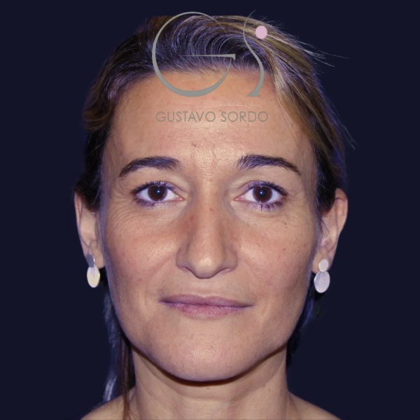 Antes y después de rinoplastia en nariz ancha