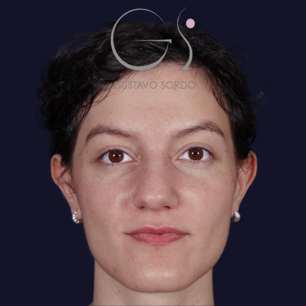 Antes y después de rinoplastia en punta bulbosa