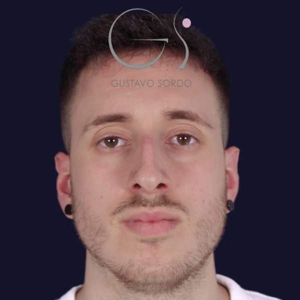Antes y después de rinoplastia en nariz masculina