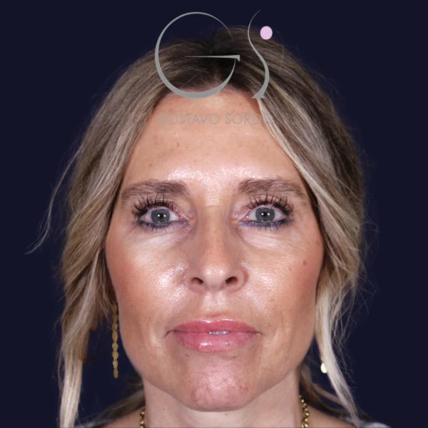 Antes y después de rinoplastia en piel gruesa