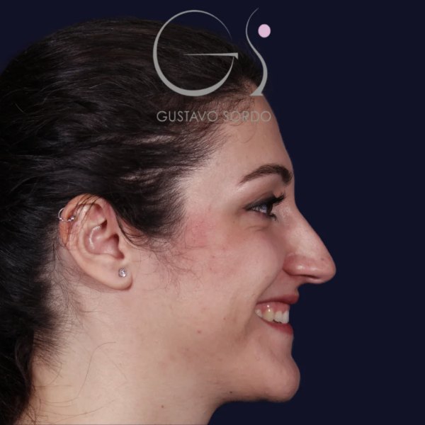 Antes y después de rinoplastia en punta caída