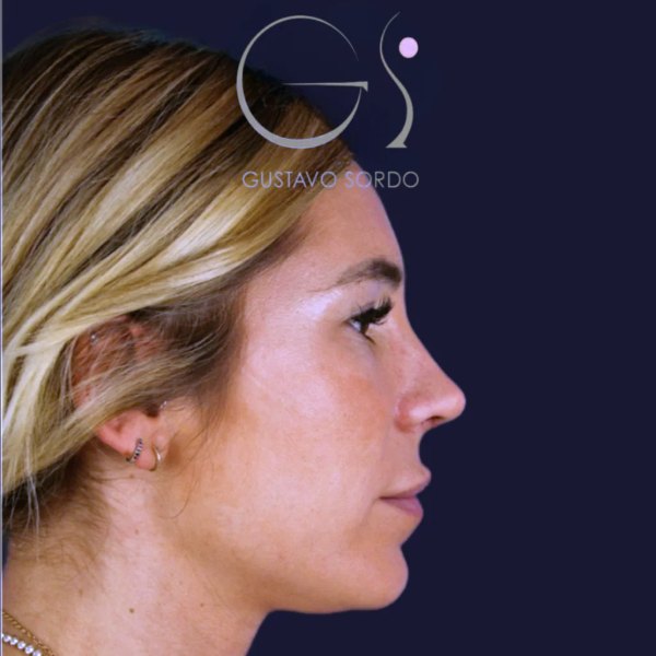 Antes y después de rinoplastia secundaria