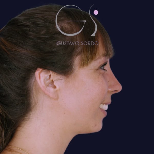 Antes y después de rinoplastia combinada con mentoplastia