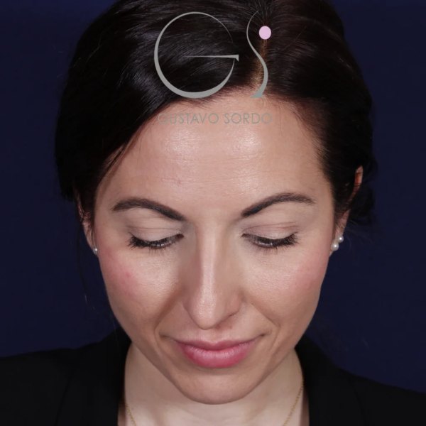 Antes y después de rinoplastia con tabique desviado