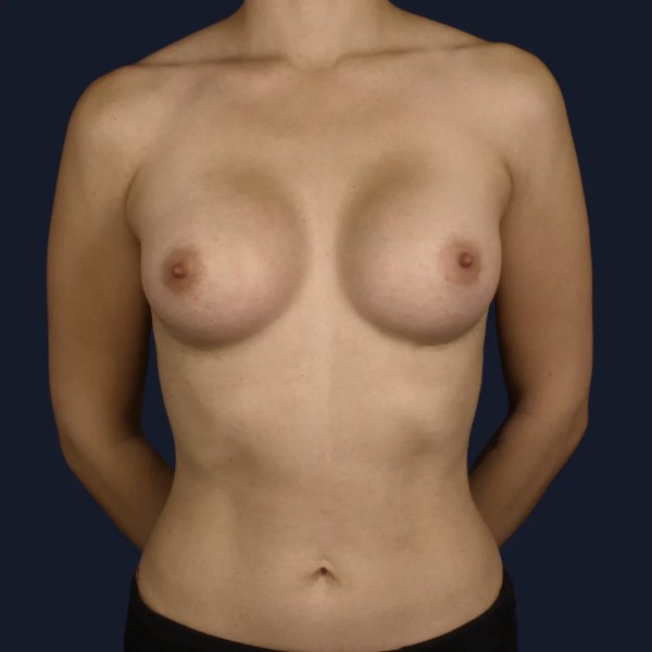Antes y después de aumento de pecho con implantes de 245-270cc