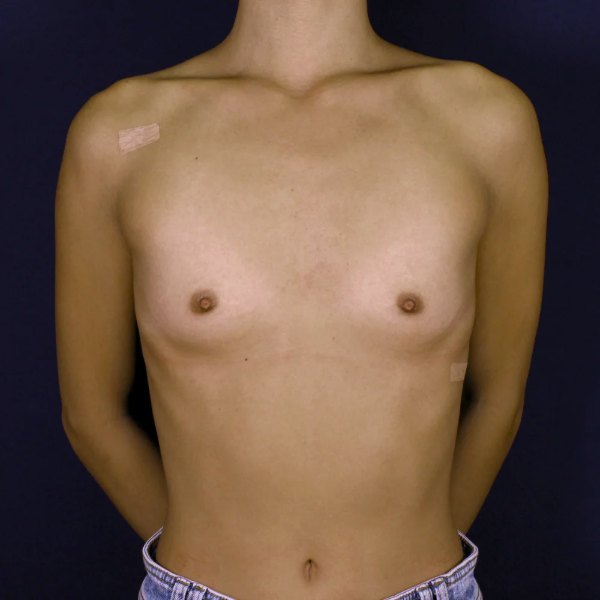 Antes y después de aumento de pecho con implantes anatómicos