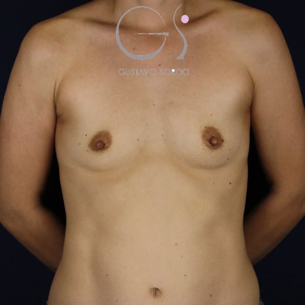 Antes y después de aumento de pecho con resultado natural